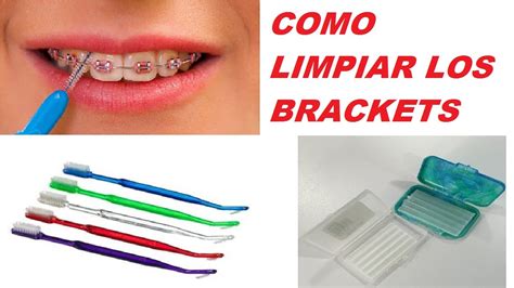 como limpiar los brackets metalicos|cleaning brackets.